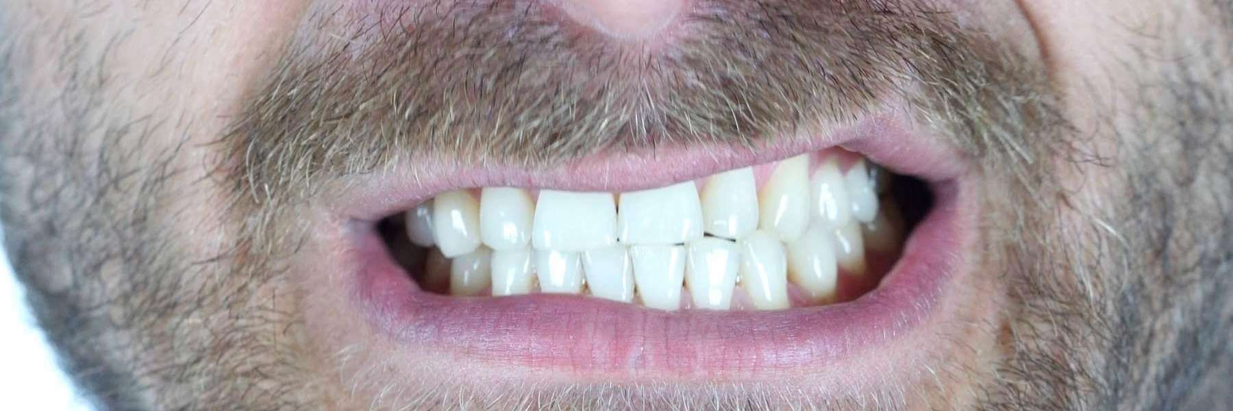Male trying to stop grinding teeth