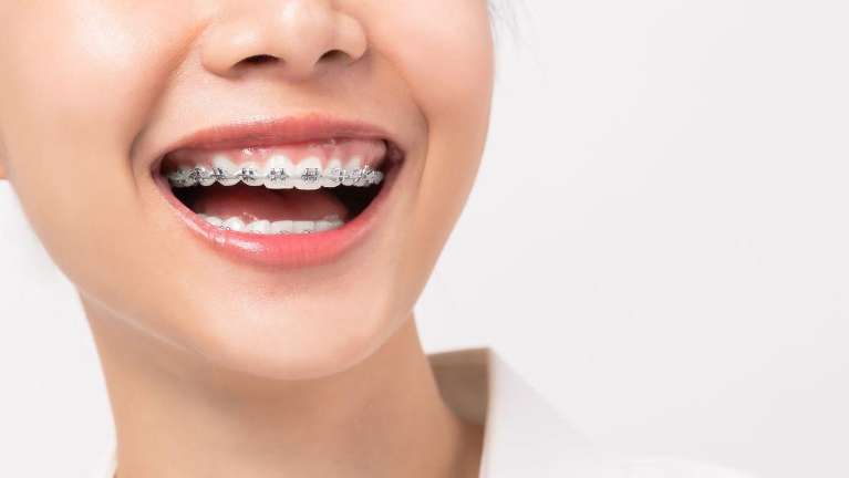 Braces