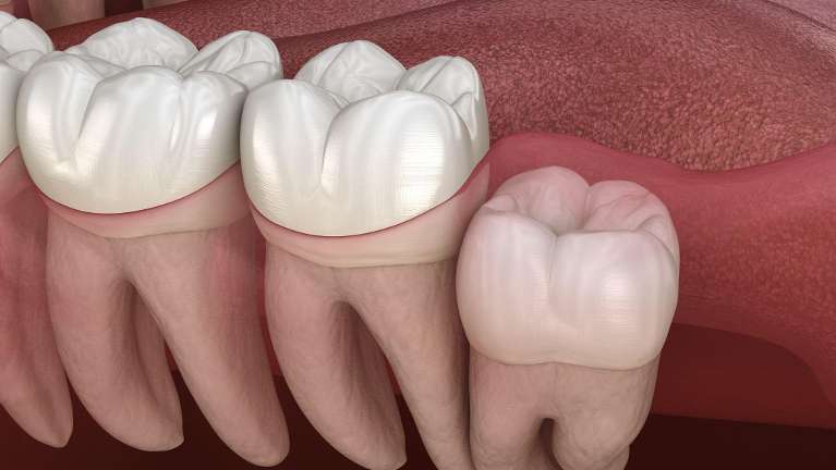 picture of a wisdom tooth