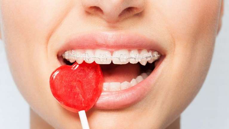 Lady with braces eating a lollipop