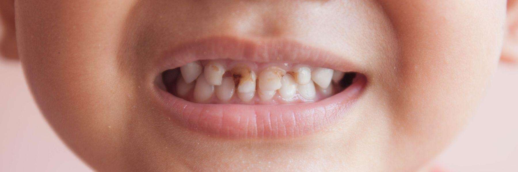 child with teeth disease