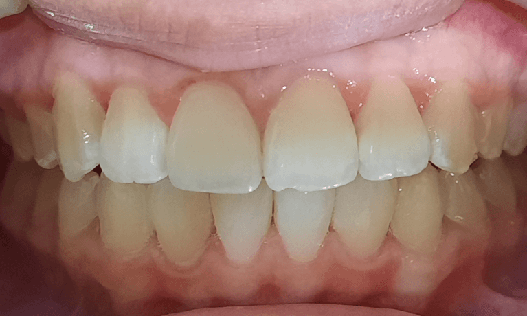 Invisalign-After-Image