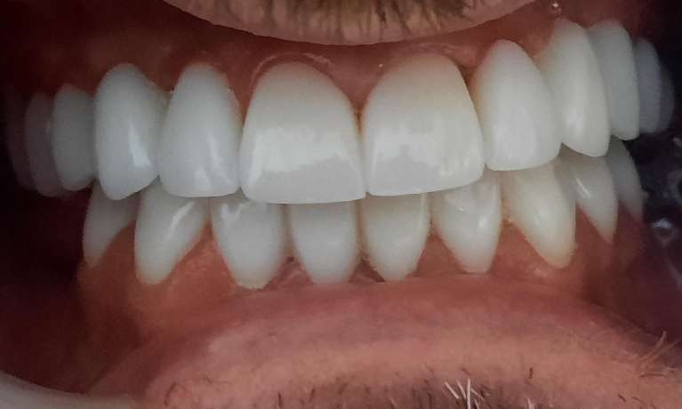 Smile-Makeover-After-Image