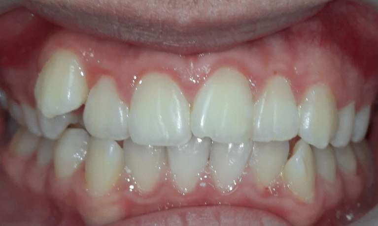 Invisalign-Before-Image