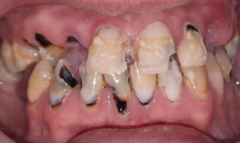 Smile-Makeover-Before-Image